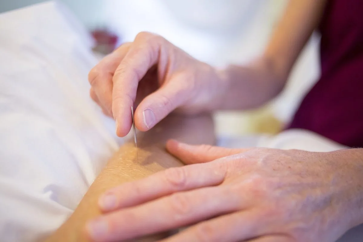 Séance d'acupuncture pour favoriser le bien-être et la détente